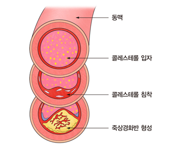  LDL콜레스테롤,콜레스테롤낮추는방법