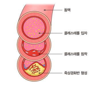 LDL콜레스테롤,콜레스테롤낮추는방법