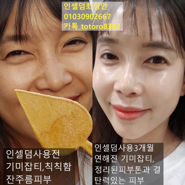 인셀덤 호전반응  왜 생길까요? 인셀덤부작용인가요? 호전반응이 뭐죠? 초기적응현상