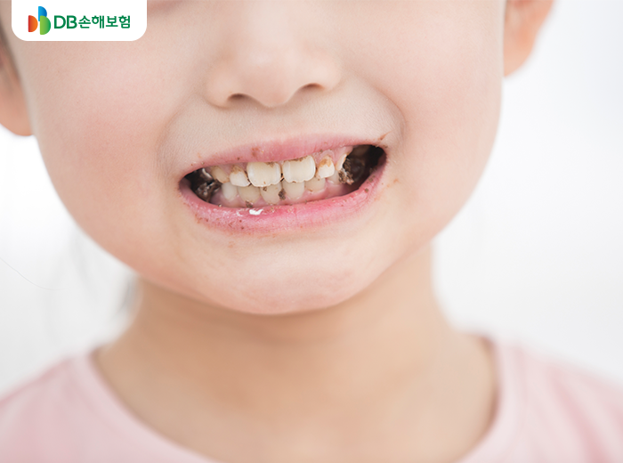 아이의 치석 스케일링 시기는?