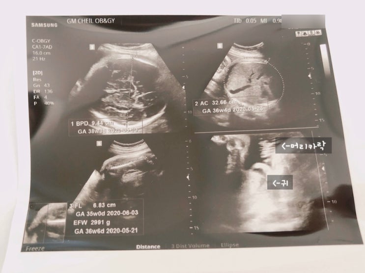[임신 34주] 초음파검사, 태아몸무게, 증상 등...