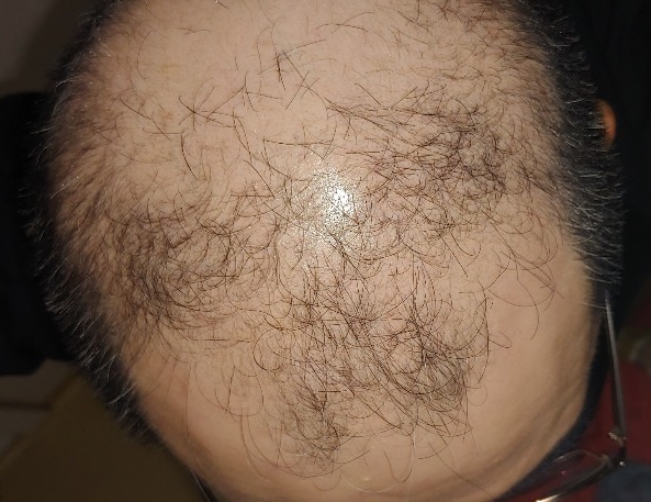  탈모치료 두타스테리드연질캡슐0.5mg(아보타드)을 병원처방으로 의료보험혜택 받아서 120일 사용한 후기내용입니다.(실비보험청구가능)