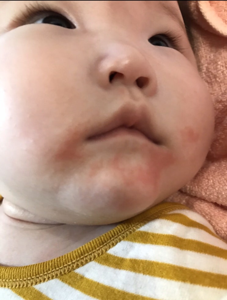 생후 6개월 아기 발달, 아기 침독크림 어떤 걸 바를까? 침독원인은? 생후 6개월 아기 발달, 아기 침독크림 어떤 걸 바를까? 침독원인은?