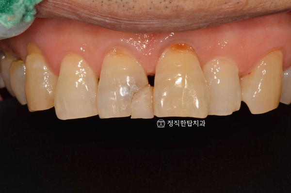  앞니 레진 변색 이유? 재치료 및 과정