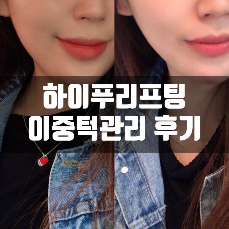  바~로 효과보이는 미유뷰티 하이푸리프팅 이중턱 관리 솔직 후기!