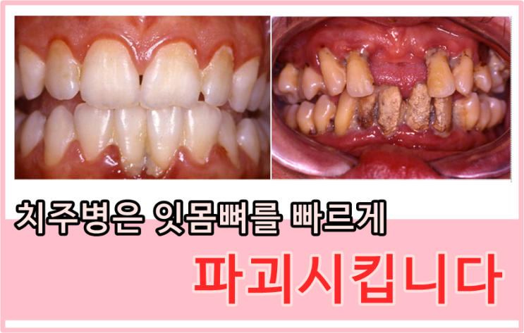  당감동치과*치주병과만성질환@감동이알려드려요
