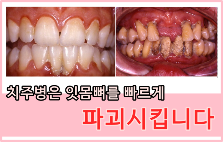 당감동치과*치주병과만성질환@감동이알려드려요