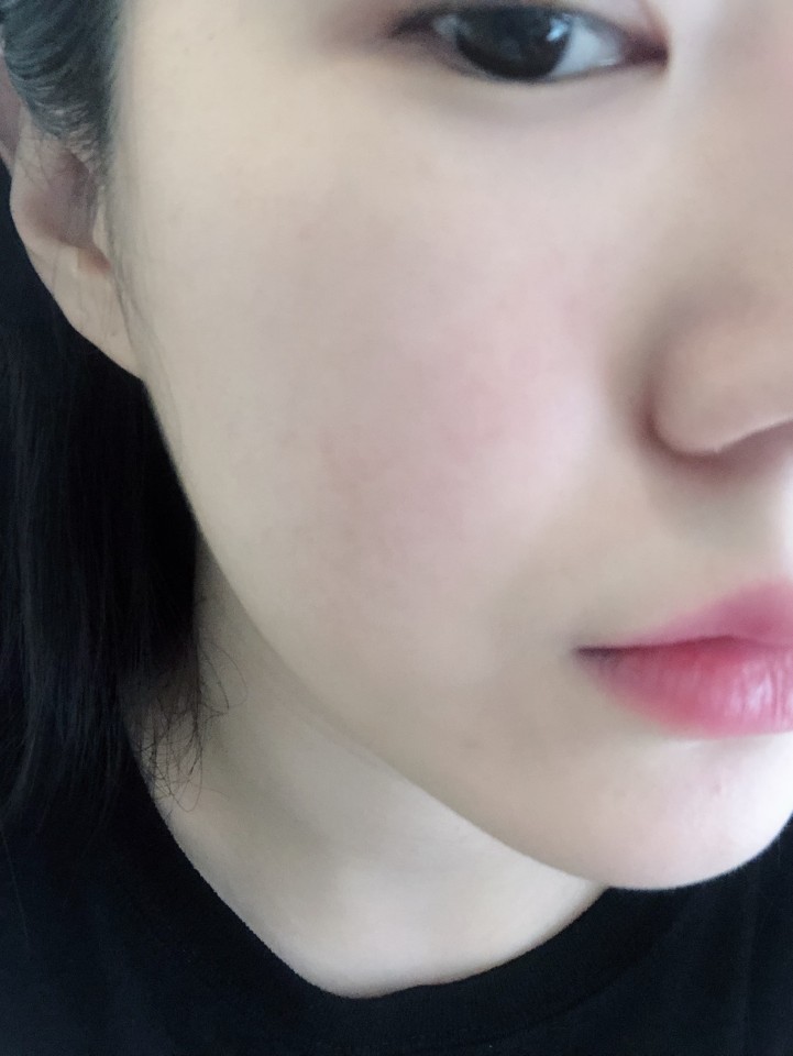  넓어진 모공, 피부개선에 MTS시술