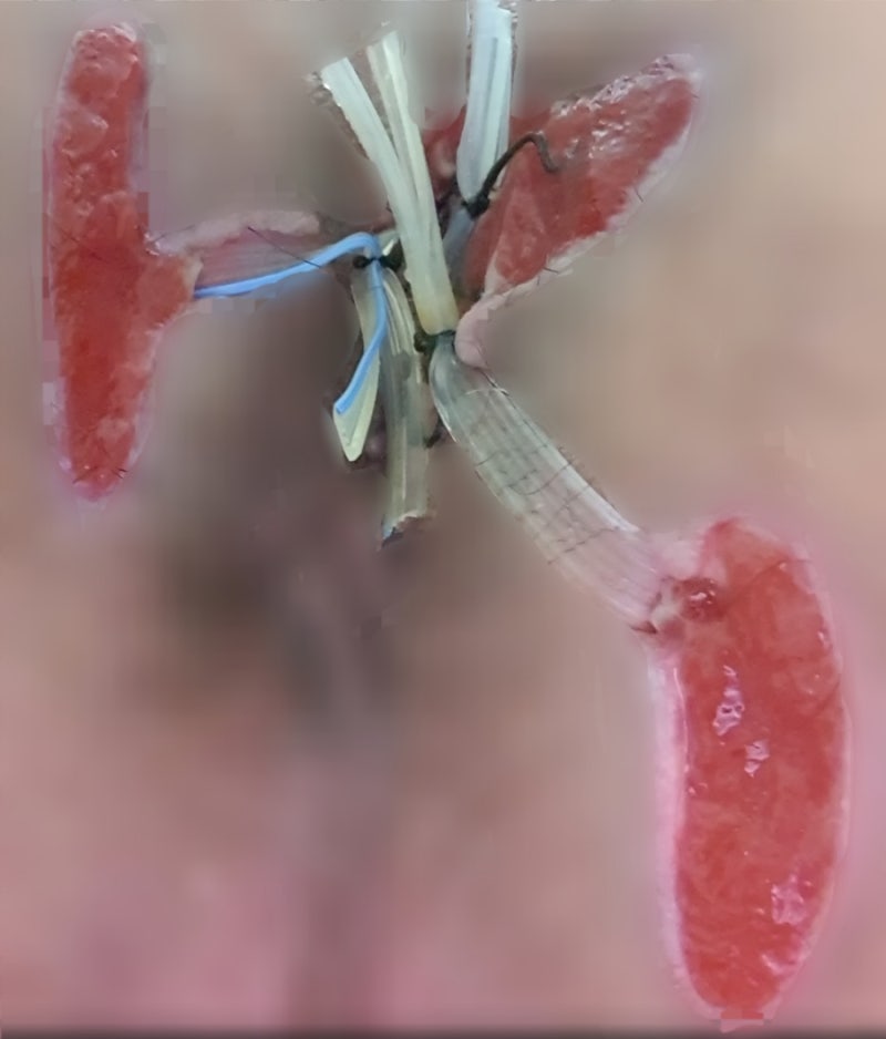 [치루수술후기 6편---복합치루 수술부위 사진들 세톤법수술 사진후기]---[2020년5월3일 서울송....