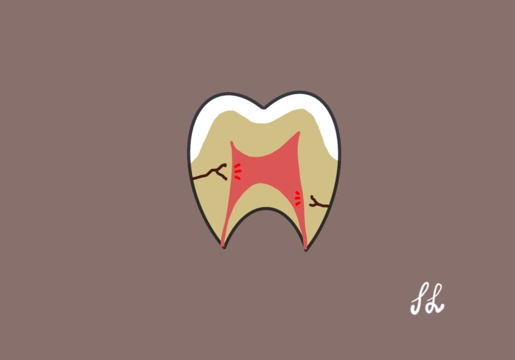  치아에 금(치아균열) 원인과 치료법, 쉽게쉽게 보세요 (Cracked tooth syndrome)
