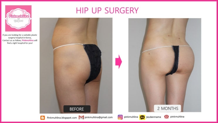 Pinkmuhlina Brazilian Butt Lift Surgery Before And After Photo 네이버 블로그