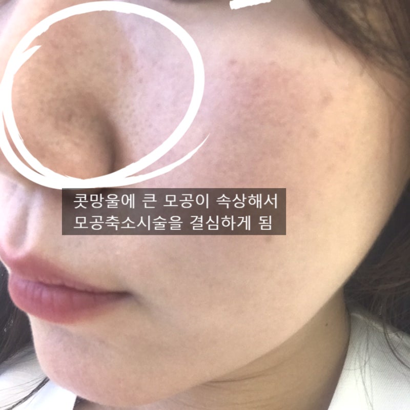 강남역피부과 모공관리에 좋은 2