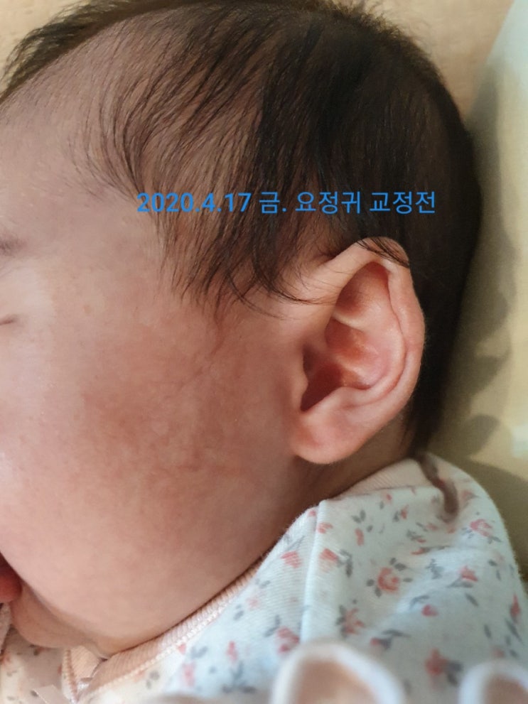 귀교정.베이비이어.요정귀 교정완료후기(2)
