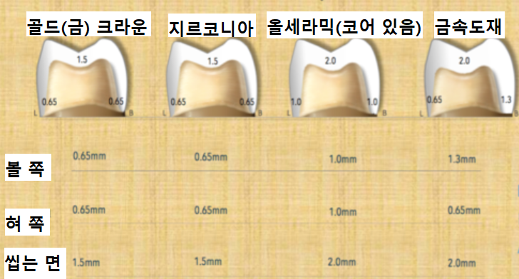  생소한 지르코니아 크라운 궁금증 타파 (feat. 가격 대비 장단점은?)