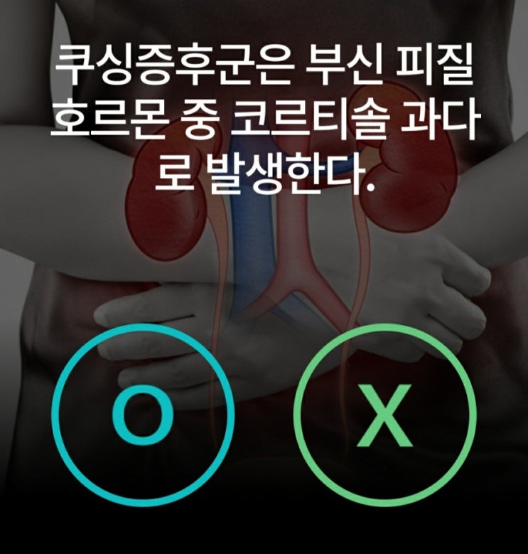  쿠싱증후군의 원인과 증상