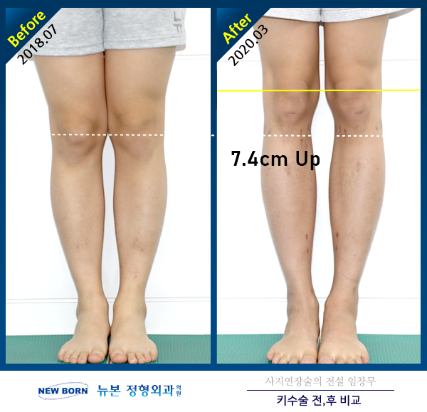 다리가 길어지는 방법 키높이 수술: 사지연장술 비용 리뷰