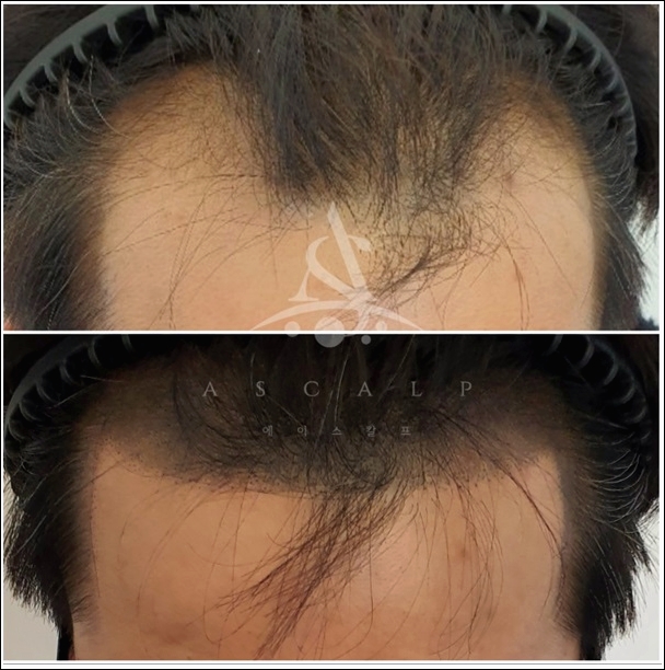  울산헤어라인 에이스칼프에서 여름준비