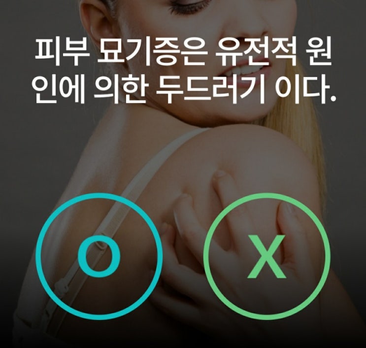  피부묘기증의 원인과 증상