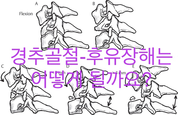  경추골절-후유장해는 어떻게 될까요?