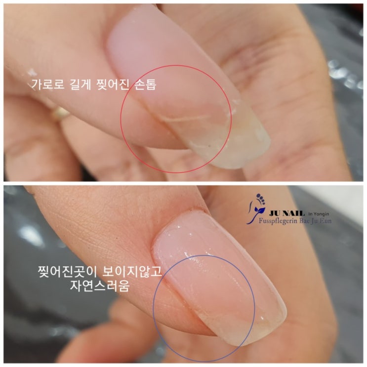 찢어진손톱 하나때문에 멀리 위례에서 오셨어요./분당용인수원수지보정동백죽전동/주네일/무좀파고드는내향성발톱손톱변형전문네일샵 찢어진손톱 하나때문에 멀리 위례에서 오셨어요./분당용인수원수지보정동백죽전동/주네일/무좀파고드는내향성발톱손톱변형전문네일샵