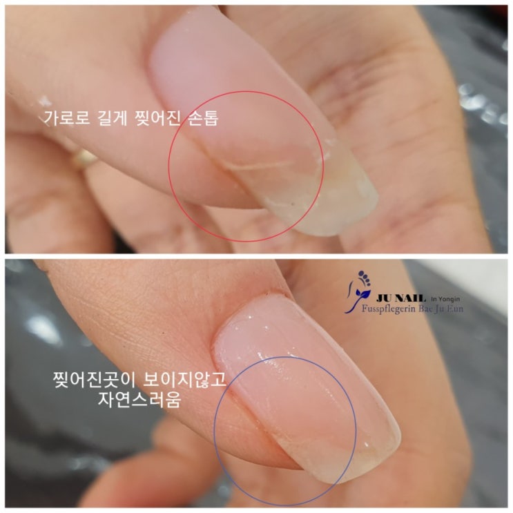 찢어진손톱 하나때문에 멀리 위례에서 오셨어요./분당용인수원수지보정동백죽전동/주네일/무좀파고드는내향성발톱손톱변형전문네일샵