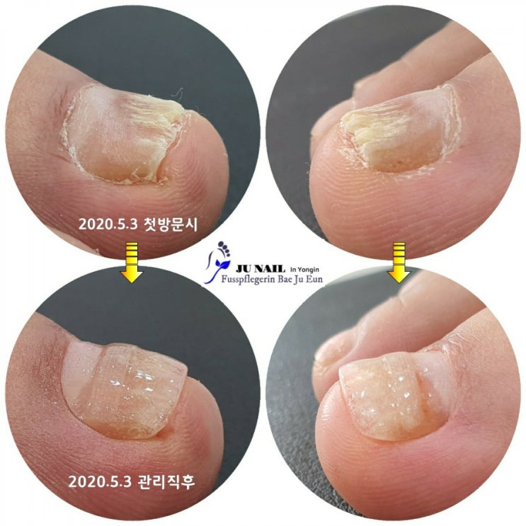 파고들어아픈발톱 자꾸신경쓰여요/분당용인수원수지보정동백죽전동/주네일/무좀파고드는내향성발톱손톱변형전문네일샵 파고들어아픈발톱 자꾸신경쓰여요/분당용인수원수지보정동백죽전동/주네일/무좀파고드는내향성발톱손톱변형전문네일샵