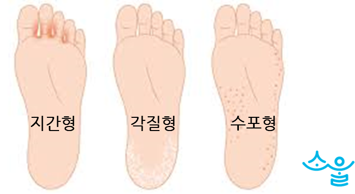 무좀약 성분 - 라미실원스, 피엠원스(테르비나핀), 피엠졸큐(클로트리마졸) 등 : 네이버 블로그
