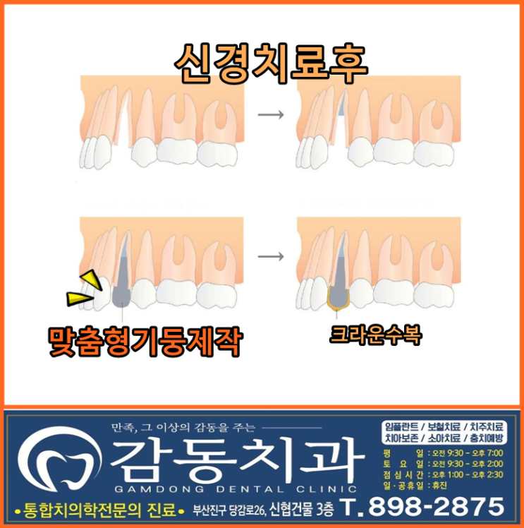  당감동치과@기둥세우기-포스트의모든것
