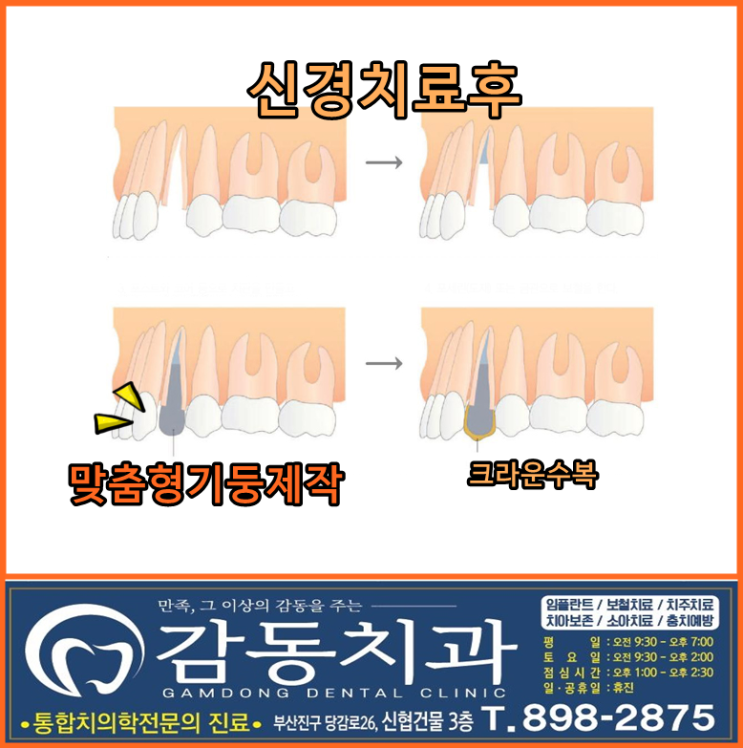 당감동치과@기둥세우기-포스트의모든것