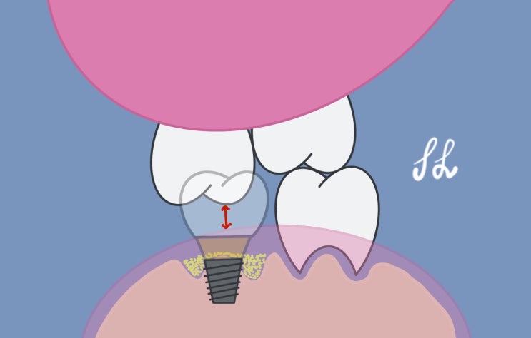 [정자역 치과] 발치하고 방치하지 마세요, 대합 치아 정출 (1)