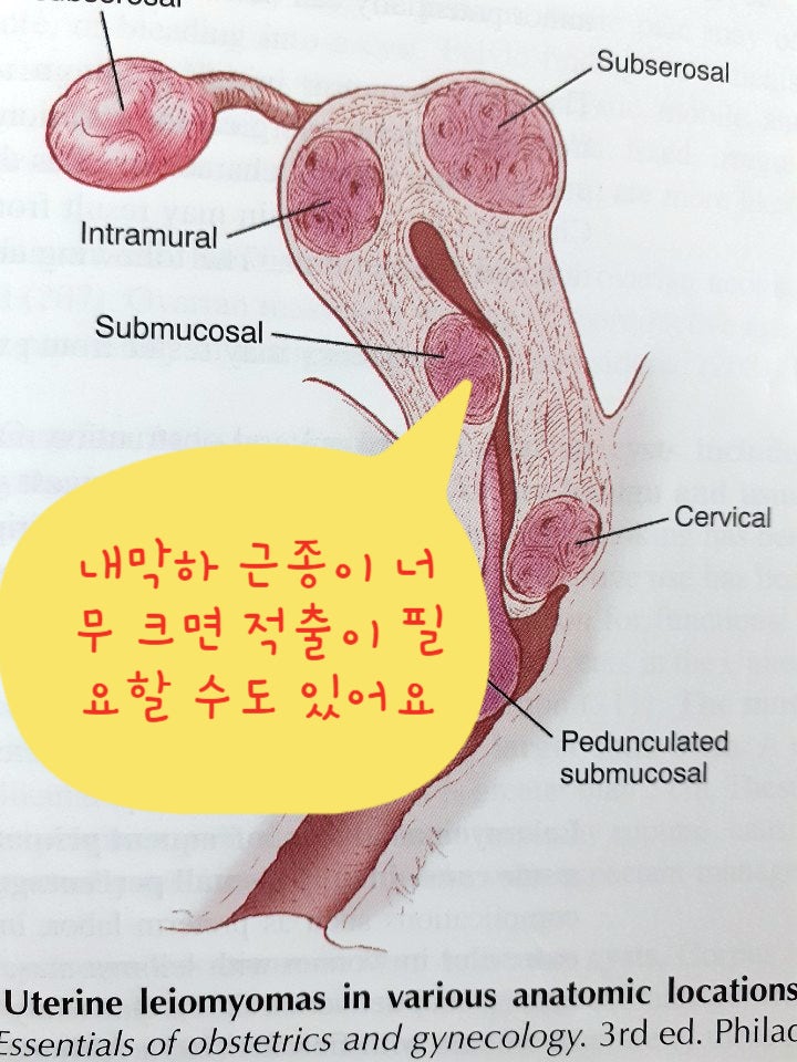 자궁절제술과 난소절제술 이후의 이야기 - 딸의 이야기 6