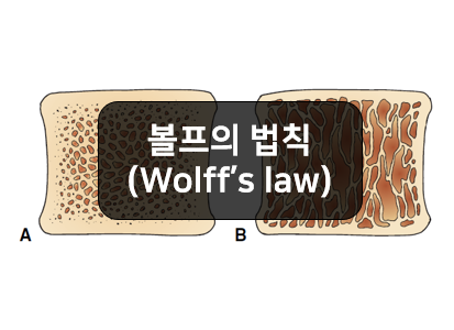  볼프의 법칙(wolff's law) 알아보기!!