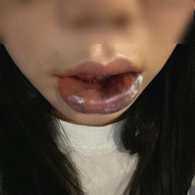  입술필러 부작용 돈 들여서 멍들고 혈관 터짐