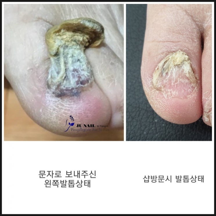 할아버지의 두껍고 변형된 무좀발톱관리/분당용인수원수지보정동백죽전동/주네일/무좀파고드는내향성발톱손톱변형전문네일샵 할아버지의 두껍고 변형된 무좀발톱관리/분당용인수원수지보정동백죽전동/주네일/무좀파고드는내향성발톱손톱변형전문네일샵