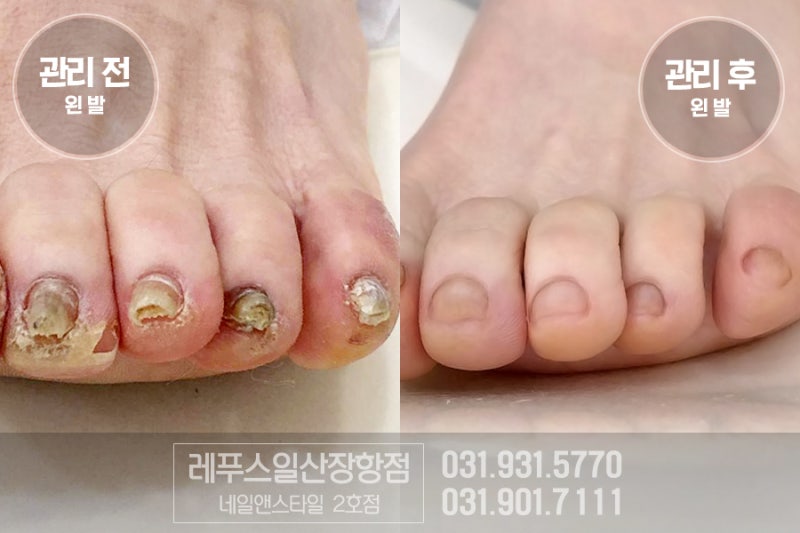 일산네일 레푸스 일산장항점 내성 발톱 7