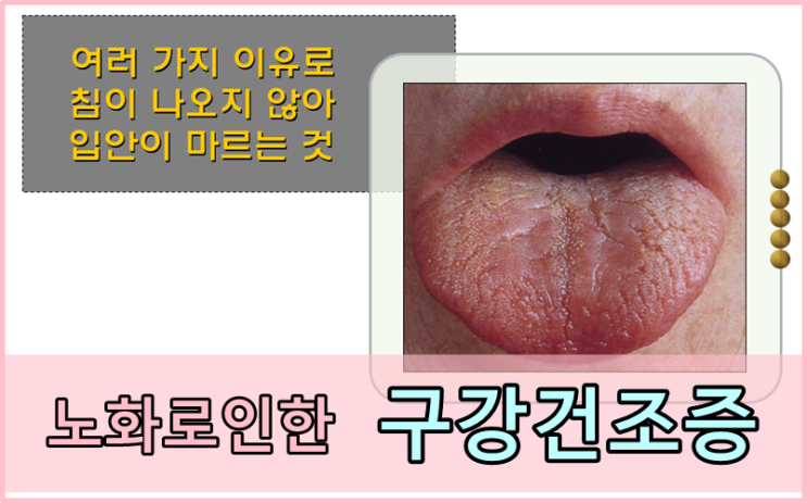  당감동치과*입안이마르는느낌@구강건조증