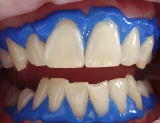 치과에서 치아미백 시술을 받으면 누구나 하얀 치아를 만들 수 있나?