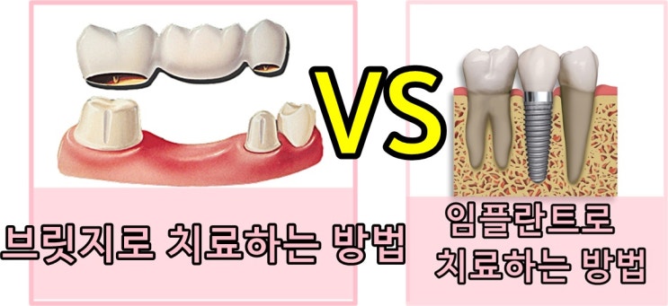  치아브릿지와임플란트치료장단점