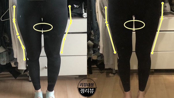 지방분해주사 HPL 승마주사 1차 리뷰