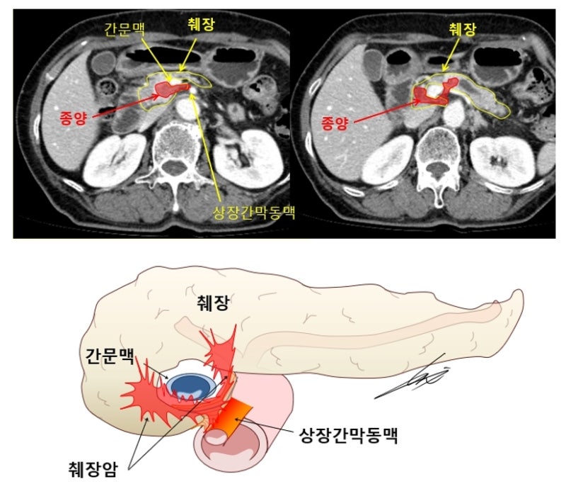 다학제로 싸운다 5편 – 진행성 췌장암, 항암치료 후 복강경 수술까지… : 네이버 블로그