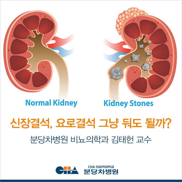 신장결석, 요로결석, 내 몸안의 돌 그냥 둬도 될까요? _비뇨의학과 김태헌 교수 : 네이버 블로그 신장결석, 요로결석, 내 몸안의 돌 그냥 둬도 될까요? _비뇨의학과 김태헌 교수 : 네이버 블로그