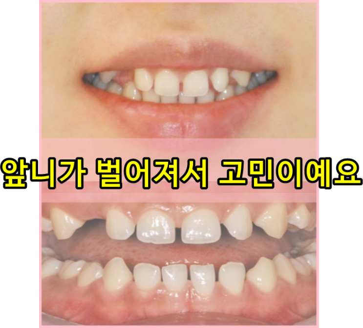  웨딩사진촬영전웃는모습이고민이라면?