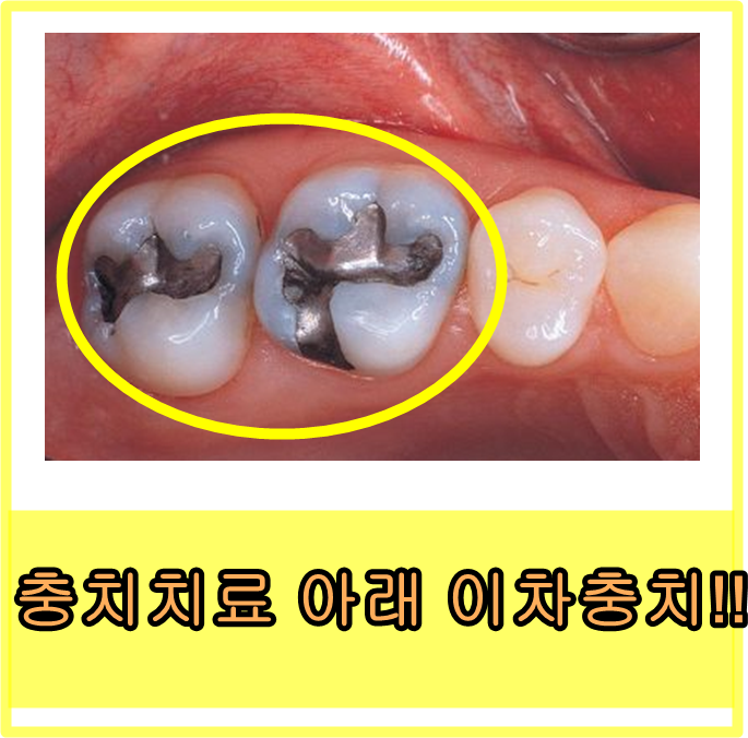  당감동치과*보철물아래이차충치