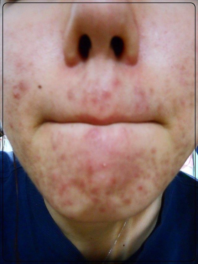 일도동 지루성 피부염 완치가 어렵다면 3