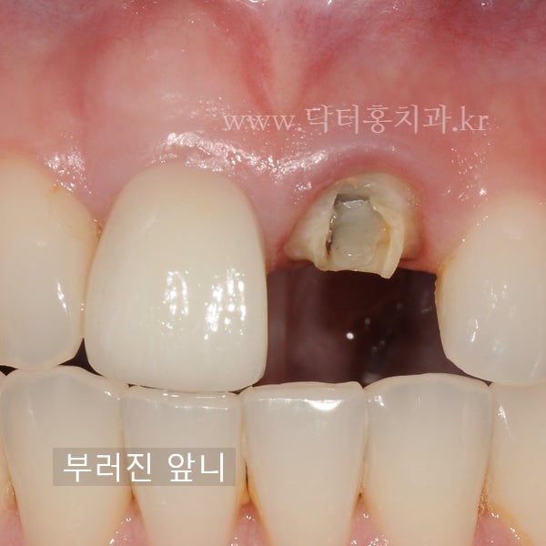 행신동 신경치료 치과- 넘어져서 부러진 앞니, 신경치료로 살려서 써보기!(1)