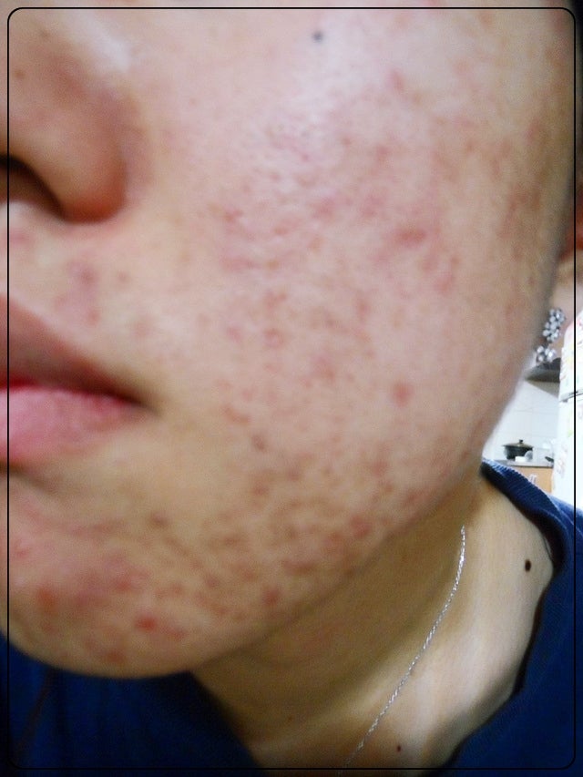 일도동 지루성 피부염 완치가 어렵다면 4