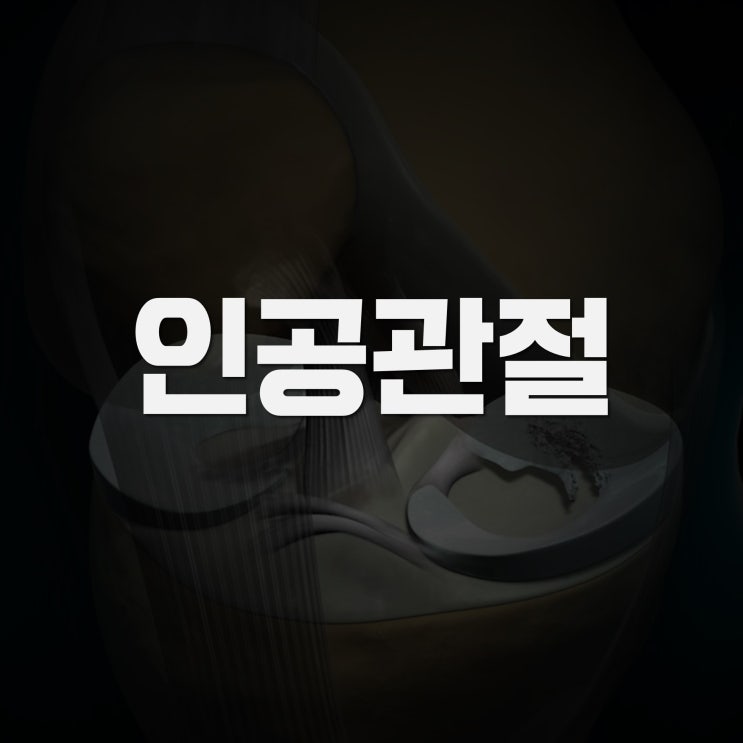 퇴행성관절염으로 아프면 인공관절수술 feat. 권제호무릎수술일지