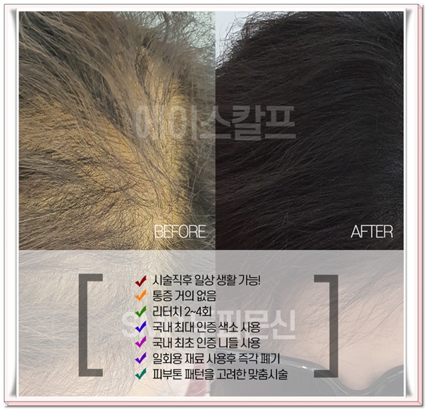  울산 남성 탈모 커버 정답은 에이스칼프