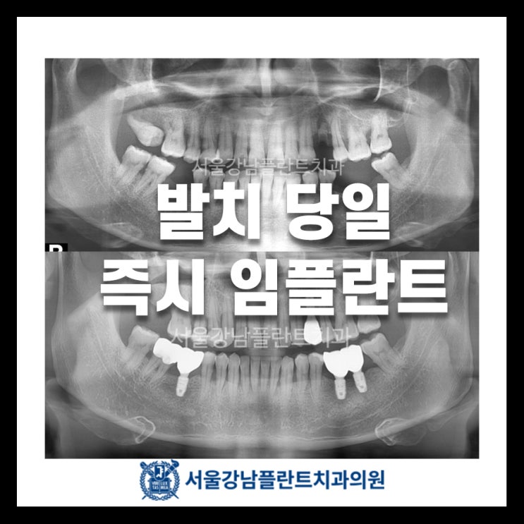 파절된 치아 발치 후 당일 임플란트 즉시 식립 케이스 (비절개 임플란트, 맞춤형 지대주)