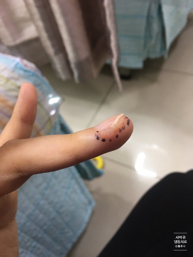 손가락 사마귀 냉동치료 받는 이야기 : 네이버 블로그